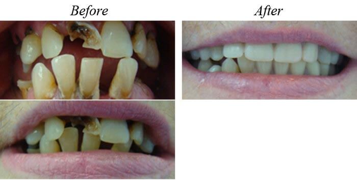 Removable Dentures Before After 02