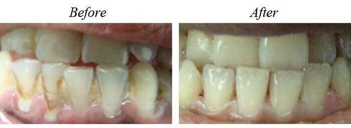 Teeth Cleaning Before After 01
