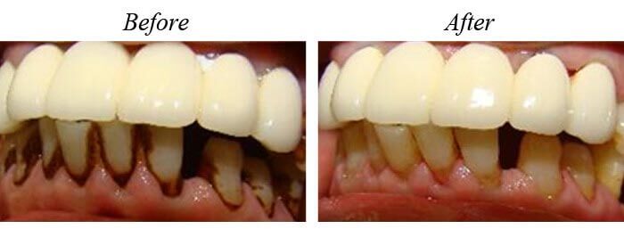 Teeth Cleaning Before After 03