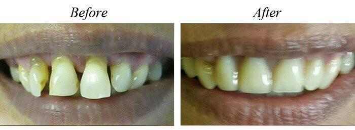 Dentures Before After 01