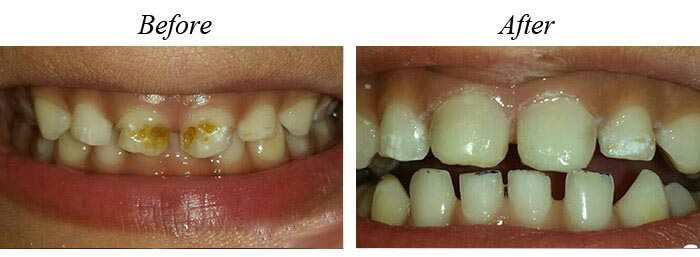 Cavities Before After 01