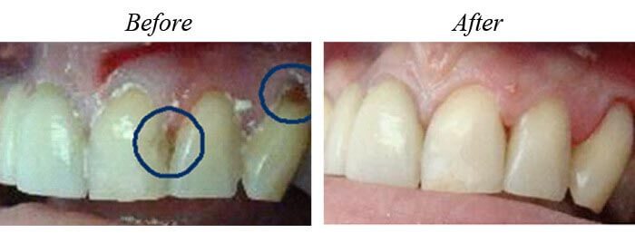 White Fillings Before After 01