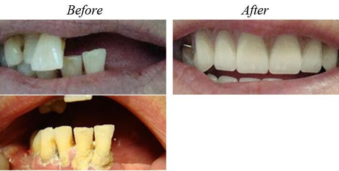 Removable Dentures Before After 01