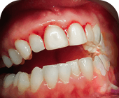 Infected Gums