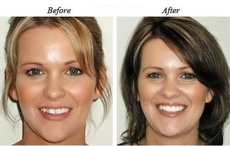 Overbite and crowding, followed by restorative treatment to fix shape and discolorations.
