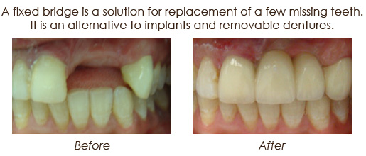 Dental Bridges Before and After