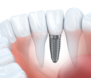 Implant Dentist Near Me Mississauga - Tooth Replacement Solutions Mississauga - Dentist L5G3H7