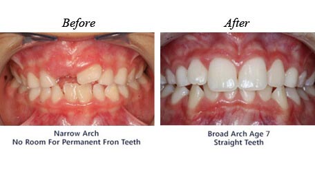 Children Orthodontics - Before After Image 1