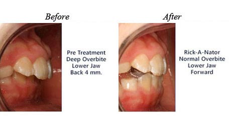 Pre and Post  Treatment Deep Overbite 