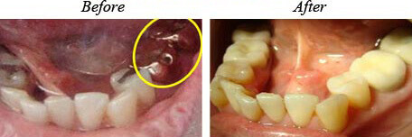 Dental Crowns Before After