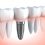 Restore Your Smile and Quality of Life with Dental Implants