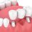 Benefits of Replacing Your Teeth with Dental Bridges