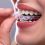 Top Benefits of Invisalign Orthodontics