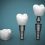 Are Dental Implants Stand-Alone Restorations for Missing Teeth?
